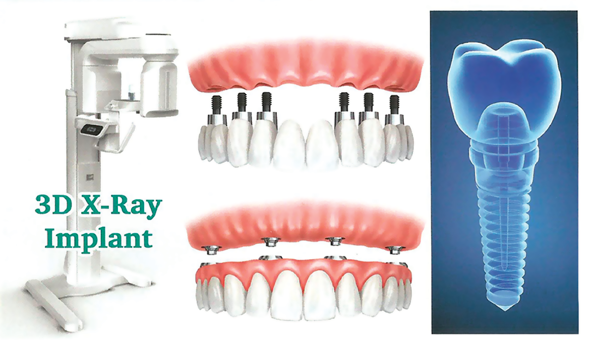 3D X-Ray Implant
